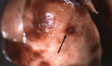 기압외상에 의한 폐 손상
